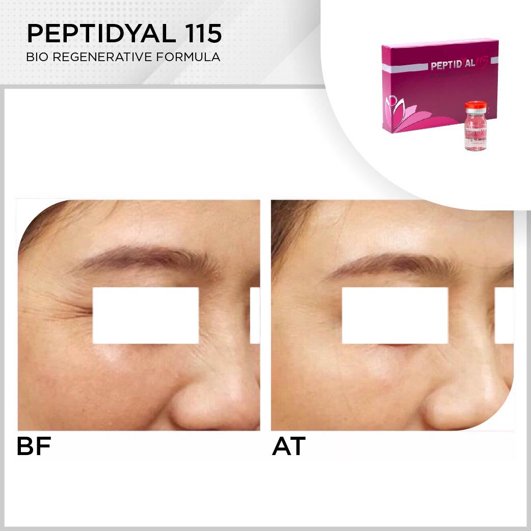 XCELENS Peptidyal 115