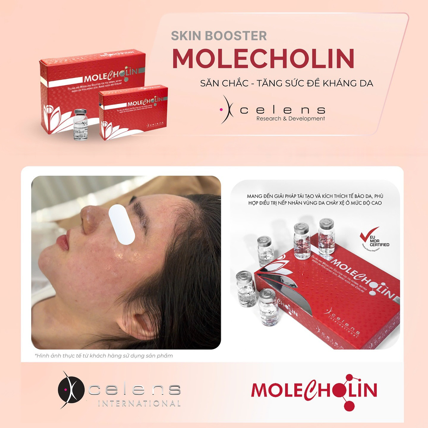 /storage/product/7/xcelens-molecholin-1.jpg