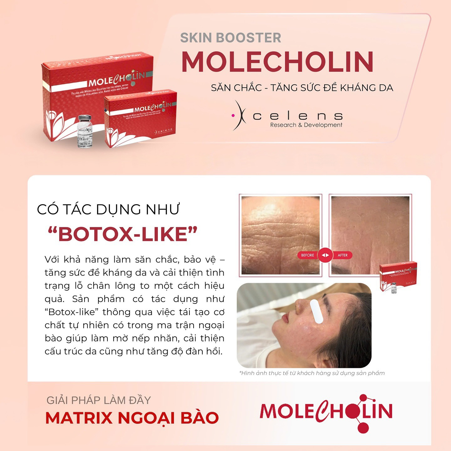 /storage/product/7/xcelens-molecholin-botox-like.jpg